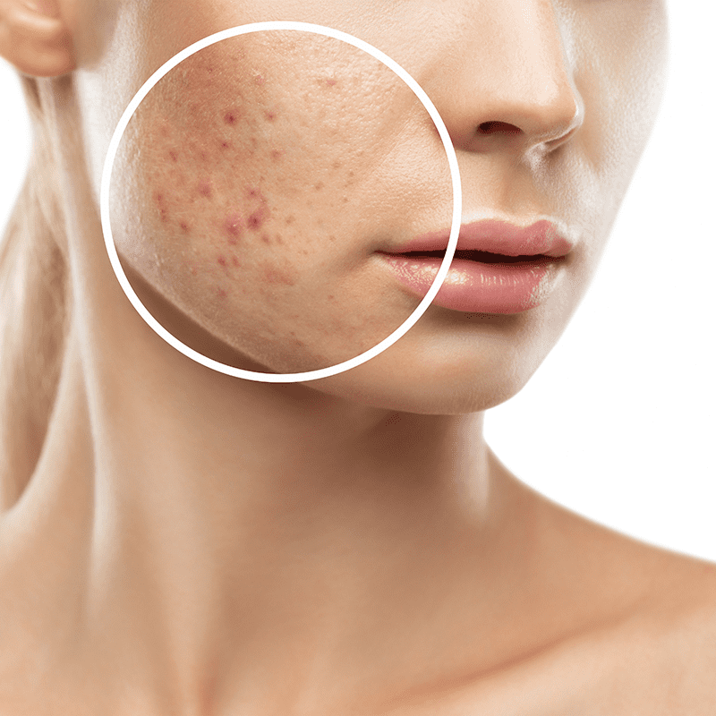 Photo d'une femme avec des boutons et de l'acné, pour représenter la problématique des problèmes de peau dans la naturopathie.